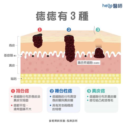 身體長黑痣|痣形成的原因？痣長毛、痣變多變大是痣病變？5招判。